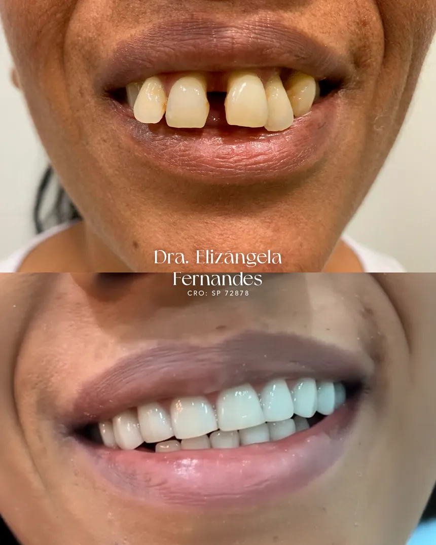 Paciente da EVOS Odontologia com o sorriso reconstruído e os espaços entre os dentes fechados