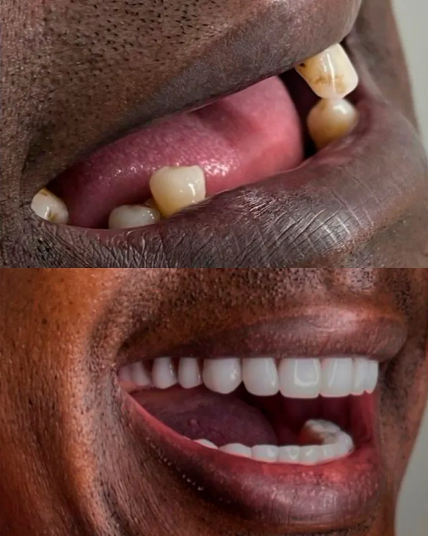 Paciente da EVOS Odontologia que recuperou os dentes posteriores e voltou a mastigar