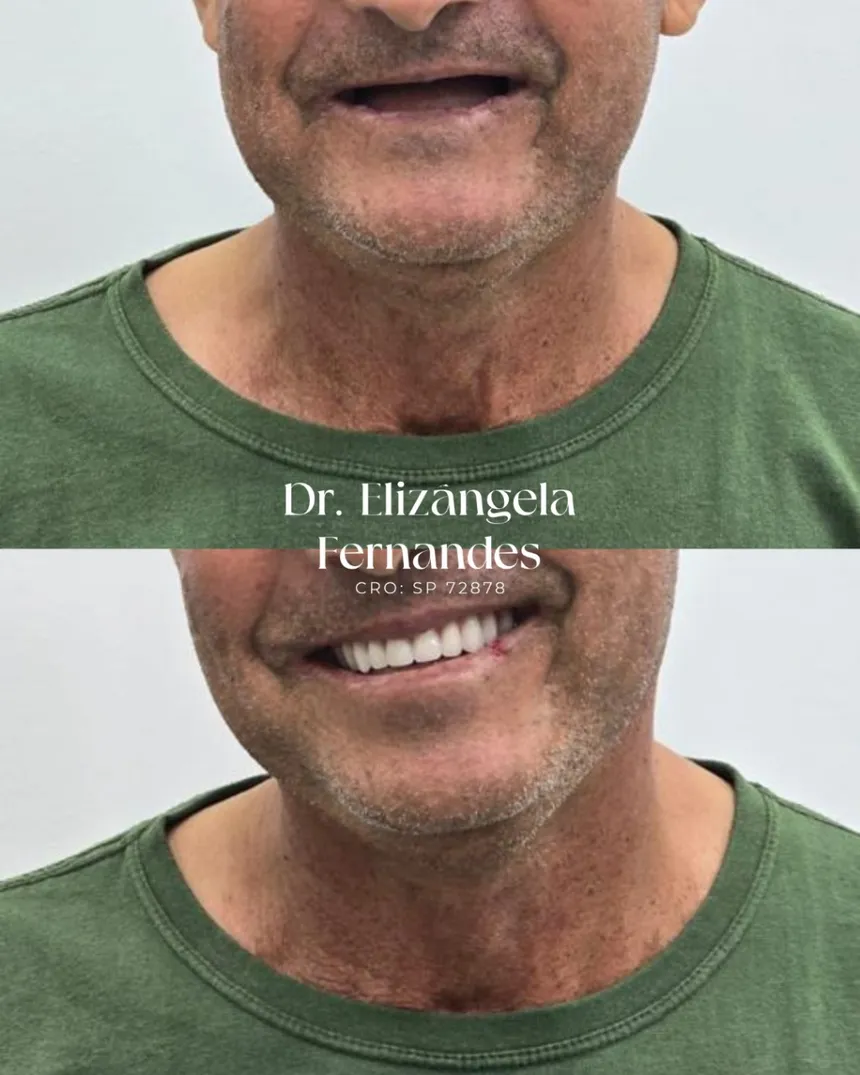 Paciente da EVOS Odontologia reabilitado com dentes fixos na arcada superior