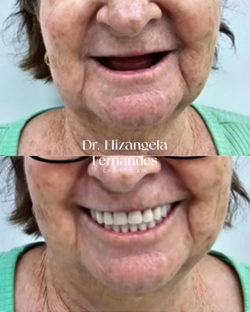 Paciente da EVOS Odontologia que substituiu a dentadura por uma prótese fixa