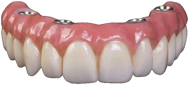 Prótese protocolo de dentes fixos, parafusada sobre implantes dentários
