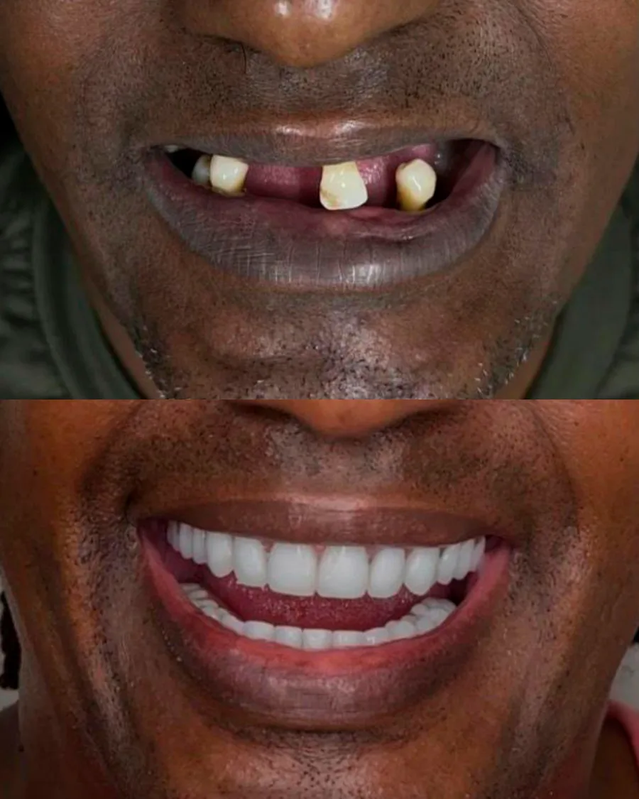 Paciente da EVOS Odontologia reabilitado com dentes fixos sobre implantes